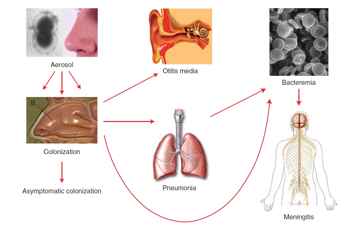 Dwoinka zapalenia płuc